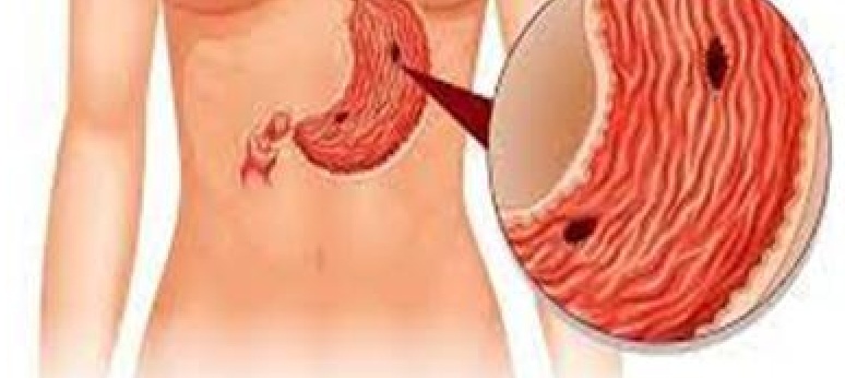 
		خبير تغذية روسي: هذا المشروب الطبيعي يقضي على الالتهاب وقرحة المعدة تماما