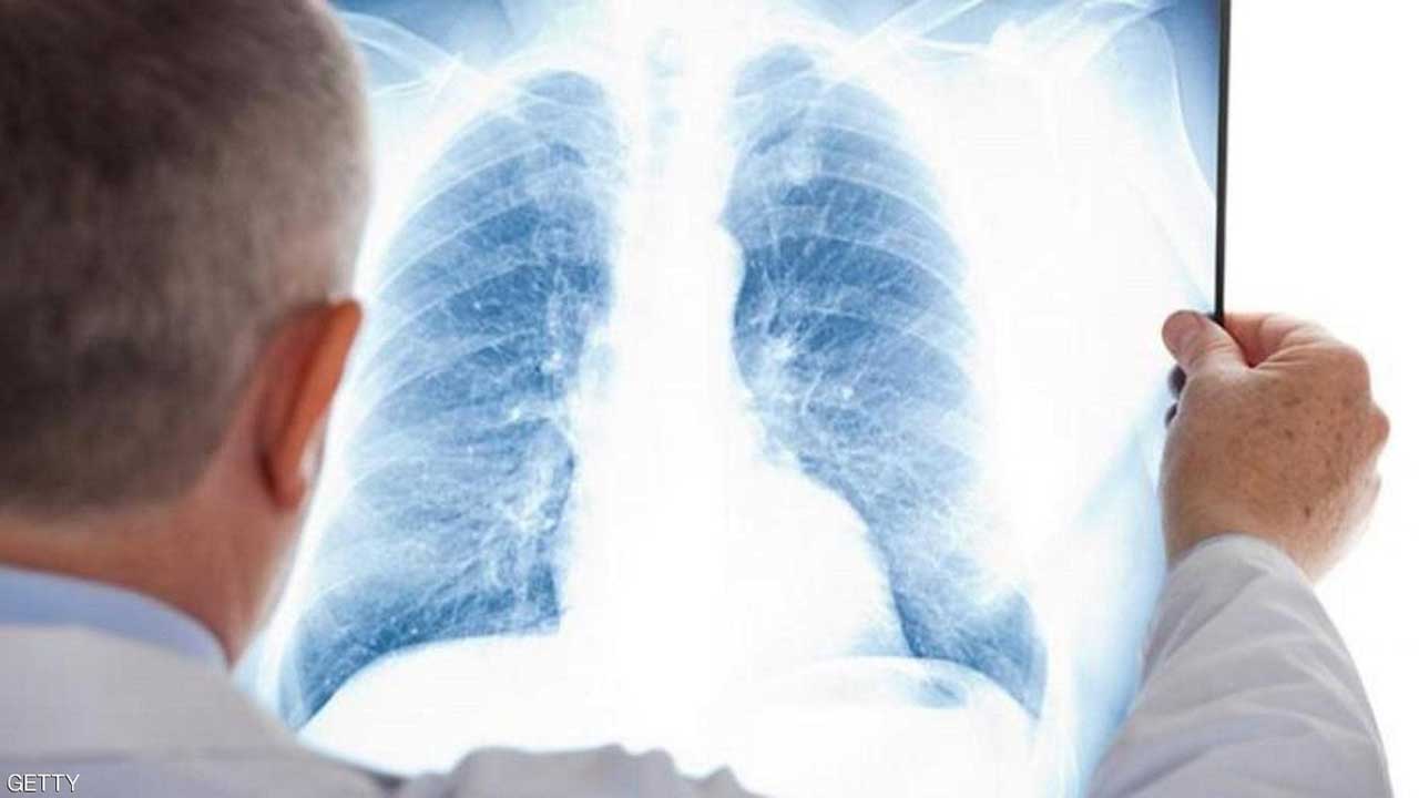 احذروا «القاتل الخفي».. تلوث الهواء سبب في بعض سرطانات الرئة