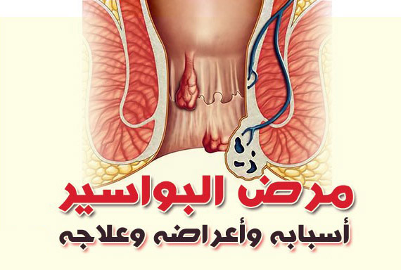 
		دون الحاجة الى طبيب .. وداعاً للبواسير .. 16 طريقة منزلية سريعة ومفعوله جبار وسحري !